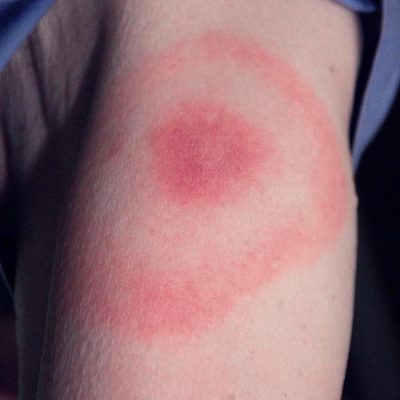 Correctional Nurse Clinical Update: Skin Assessment: Common Lesions