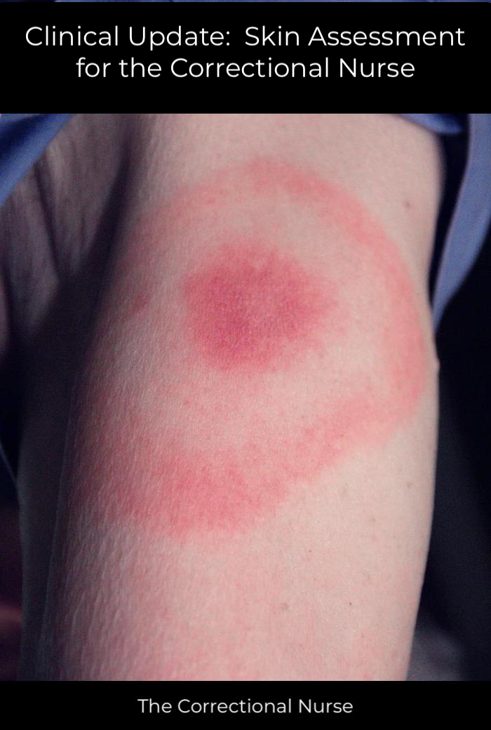 Correctional Nurse Clinical Update: Skin Assessment