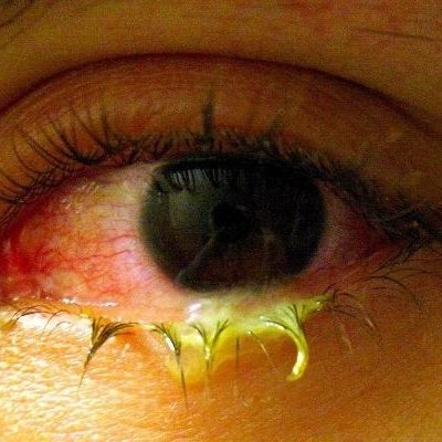 Correctional Nurse Clinical Practice Update:  Red Eye – Conjunctivitis