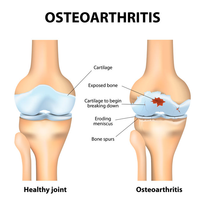 A kézízület károsodása Kopásos ízületi megbetegedés (arthrosis, osteoarthritis)